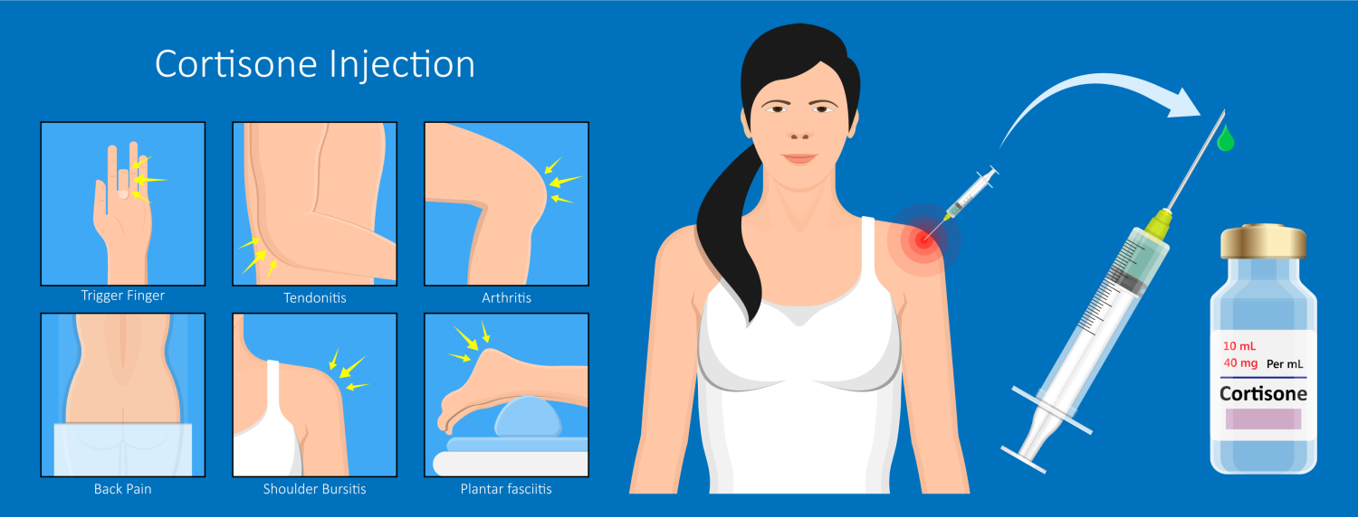 Joint Injections Beacon Orthopaedics and Sports Medicine Erlanger, KY