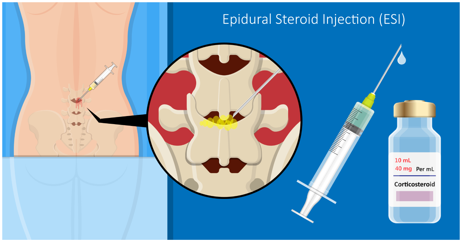 Epidural Steroid Injections Beacon Orthopaedics and Sports Medicine